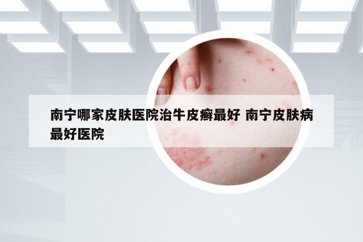 南宁哪家皮肤医院治牛皮癣最好 南宁皮肤病最好医院
