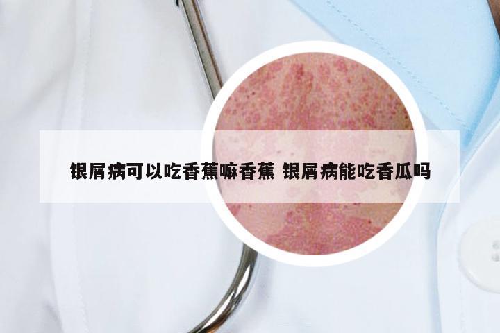 银屑病可以吃香蕉嘛香蕉 银屑病能吃香瓜吗