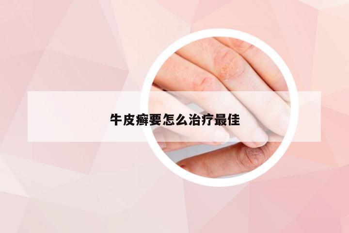 牛皮癣要怎么治疗最佳