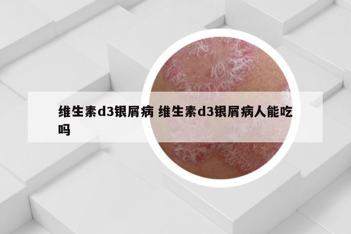 维生素d3银屑病 维生素d3银屑病人能吃吗