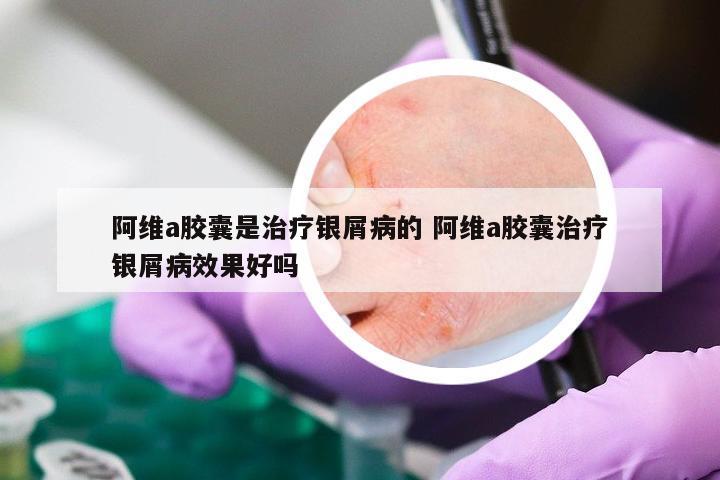 阿维a胶囊是治疗银屑病的 阿维a胶囊治疗银屑病效果好吗