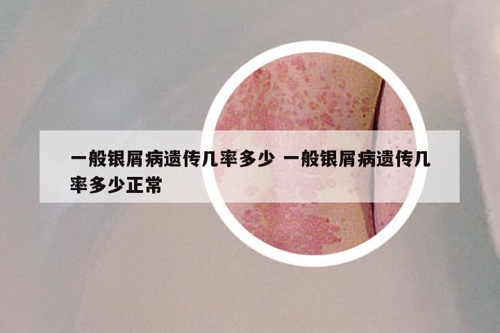 一般银屑病遗传几率多少 一般银屑病遗传几率多少正常