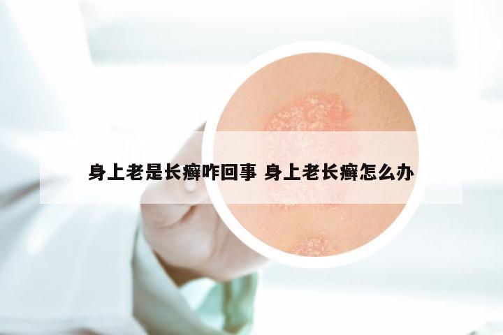 身上老是长癣咋回事 身上老长癣怎么办