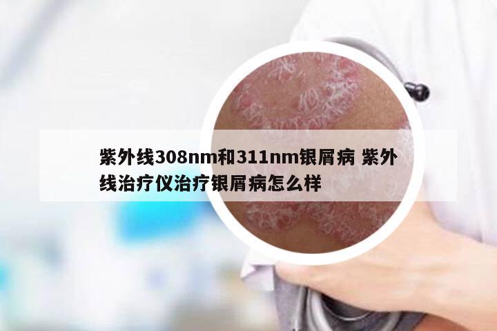 紫外线308nm和311nm银屑病 紫外线治疗仪治疗银屑病怎么样
