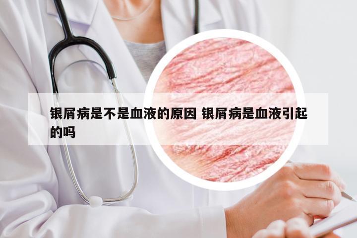 银屑病是不是血液的原因 银屑病是血液引起的吗