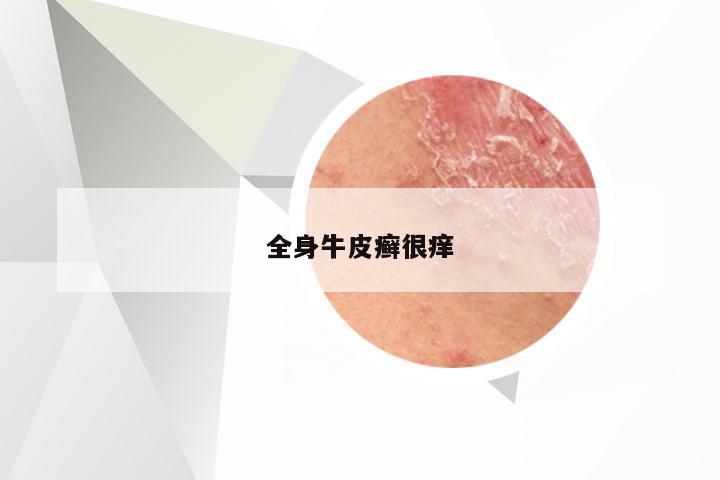 全身牛皮癣很痒