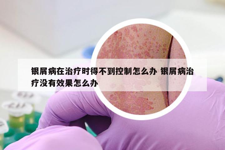 银屑病在治疗时得不到控制怎么办 银屑病治疗没有效果怎么办