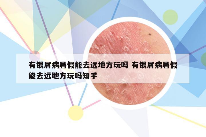 有银屑病暑假能去远地方玩吗 有银屑病暑假能去远地方玩吗知乎