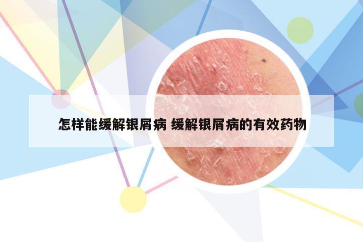 怎样能缓解银屑病 缓解银屑病的有效药物