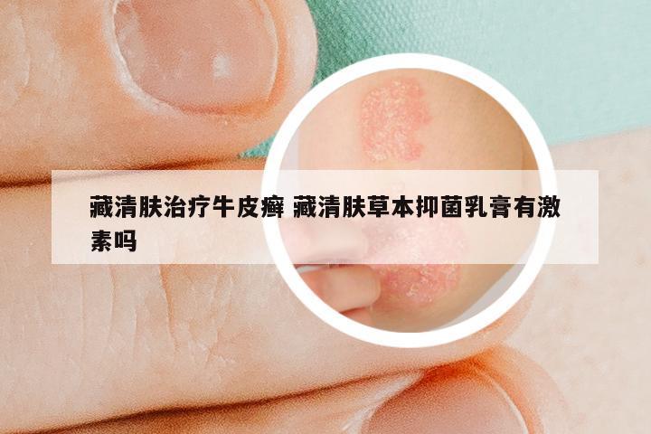 藏清肤治疗牛皮癣 藏清肤草本抑菌乳膏有激素吗
