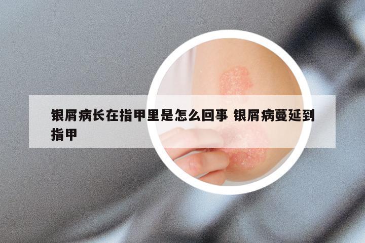 银屑病长在指甲里是怎么回事 银屑病蔓延到指甲