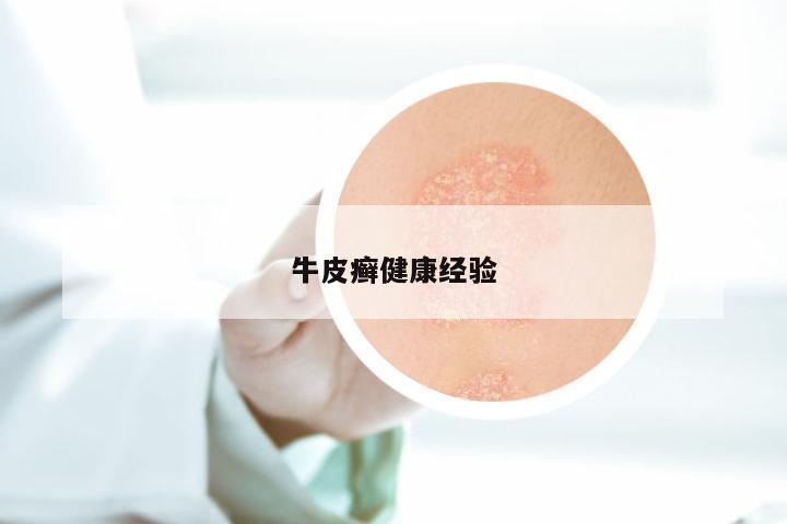 牛皮癣健康经验