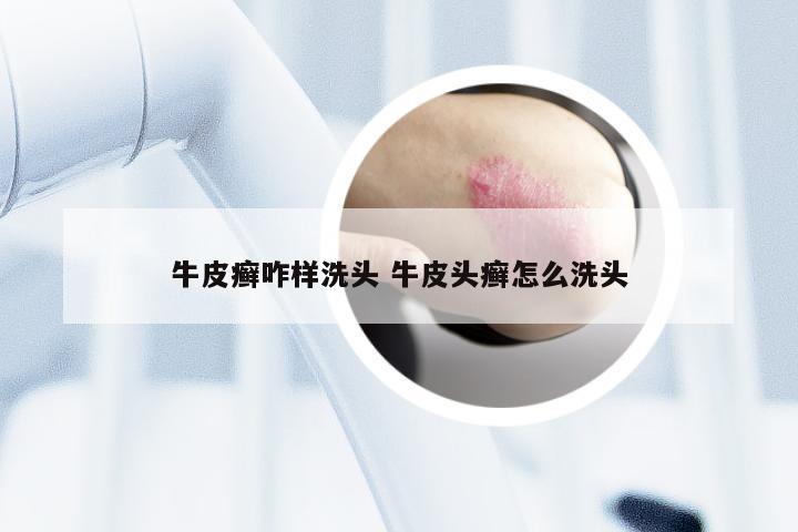 牛皮癣咋样洗头 牛皮头癣怎么洗头