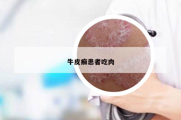 牛皮癣患者吃肉