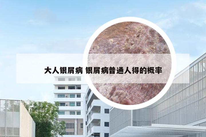 大人银屑病 银屑病普通人得的概率