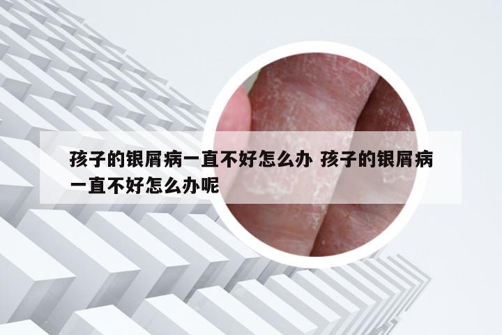 孩子的银屑病一直不好怎么办 孩子的银屑病一直不好怎么办呢