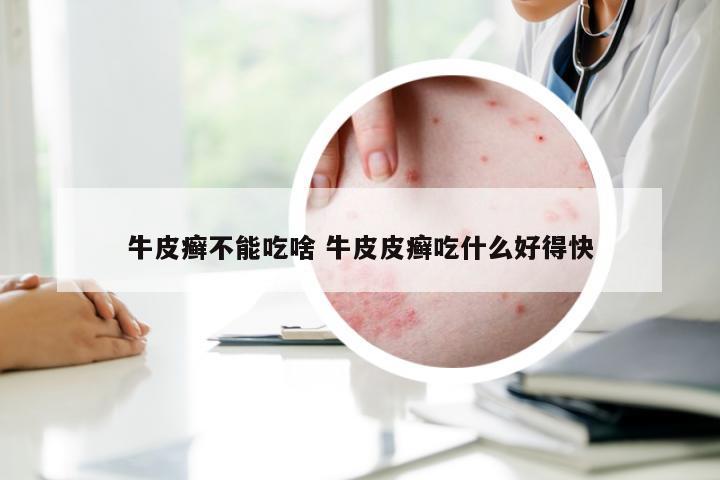 牛皮癣不能吃啥 牛皮皮癣吃什么好得快