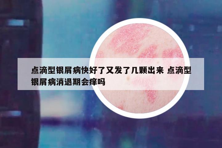 点滴型银屑病快好了又发了几颗出来 点滴型银屑病消退期会痒吗