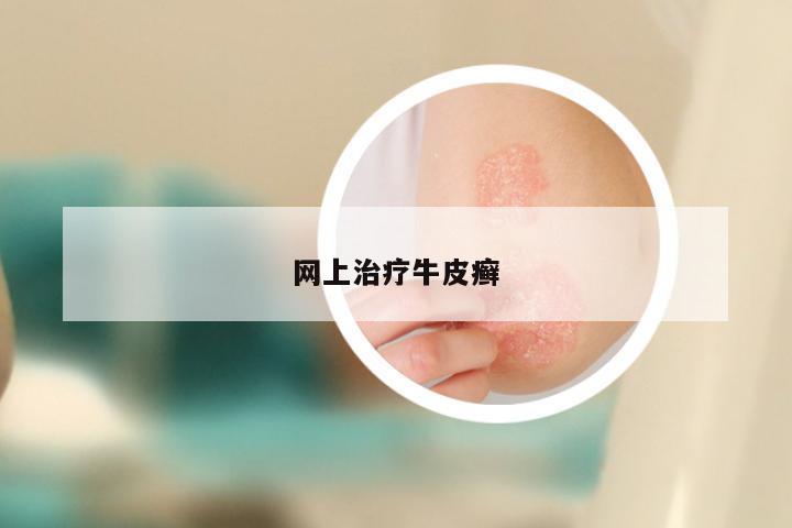 网上治疗牛皮癣