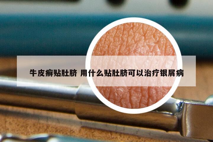 牛皮癣贴肚脐 用什么贴肚脐可以治疗银屑病