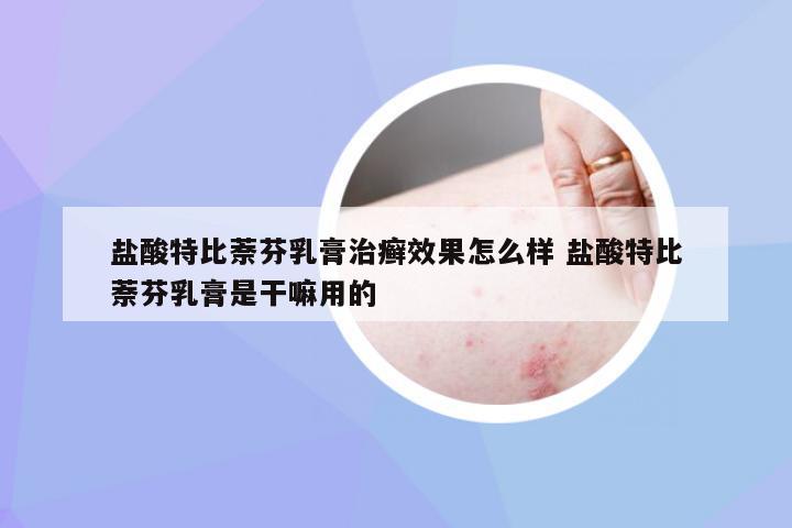 盐酸特比萘芬乳膏治癣效果怎么样 盐酸特比萘芬乳膏是干嘛用的