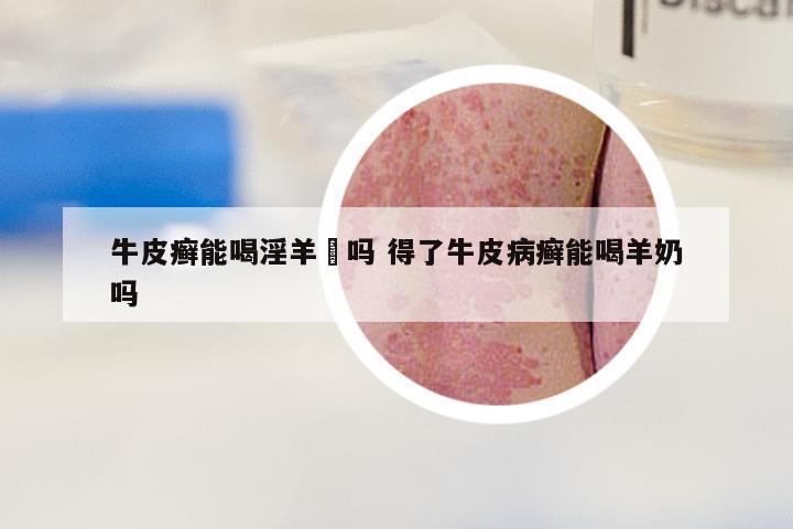 牛皮癣能喝淫羊蒮吗 得了牛皮病癣能喝羊奶吗