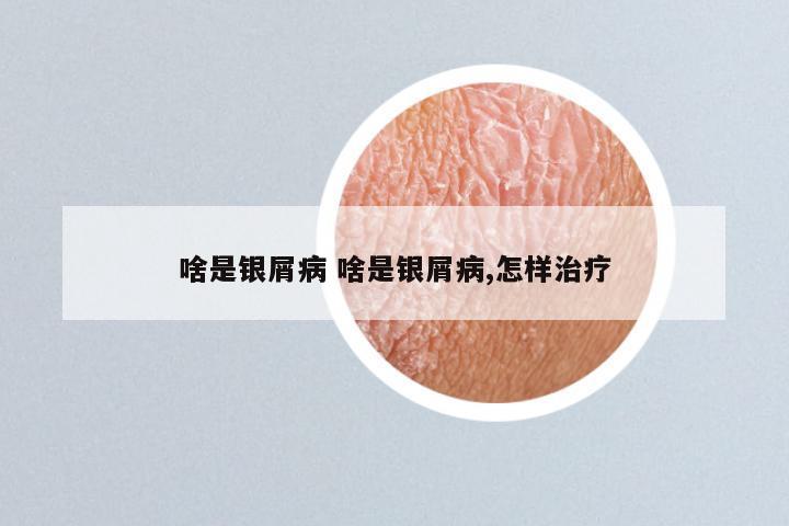 啥是银屑病 啥是银屑病,怎样治疗