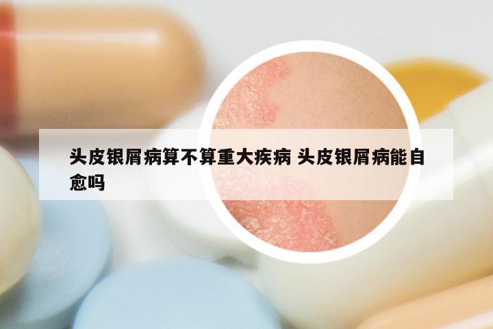 头皮银屑病算不算重大疾病 头皮银屑病能自愈吗