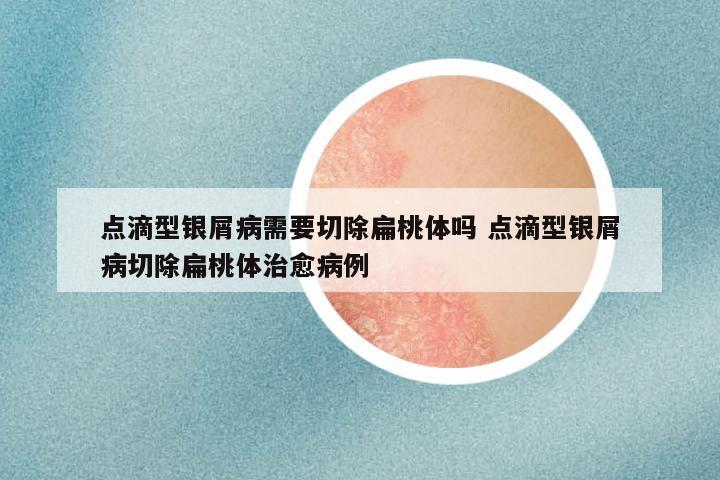 点滴型银屑病需要切除扁桃体吗 点滴型银屑病切除扁桃体治愈病例