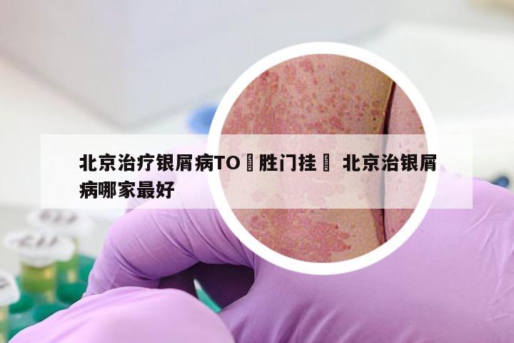 北京治疗银屑病TO徳胜门挂號 北京治银屑病哪家最好