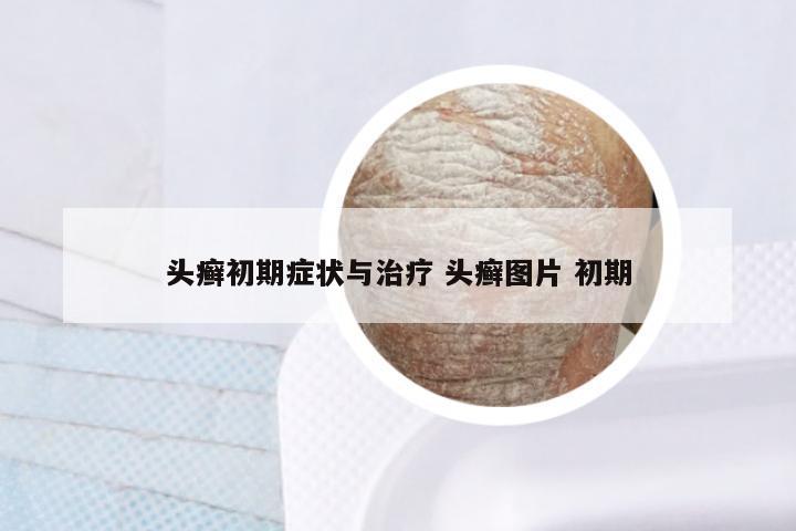 头癣初期症状与治疗 头癣图片 初期