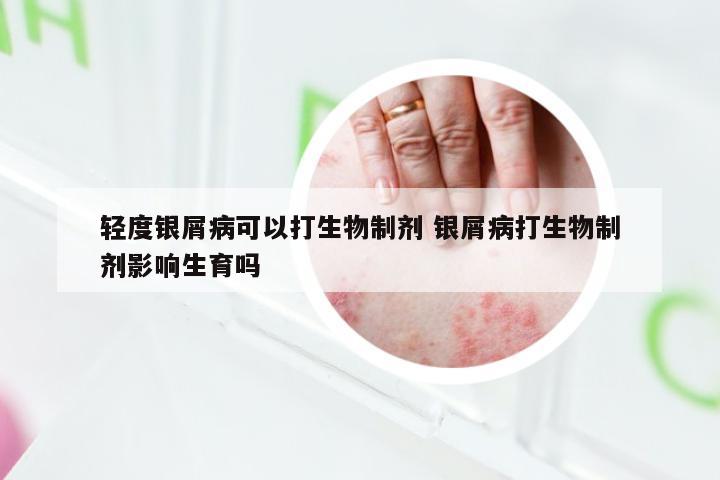 轻度银屑病可以打生物制剂 银屑病打生物制剂影响生育吗