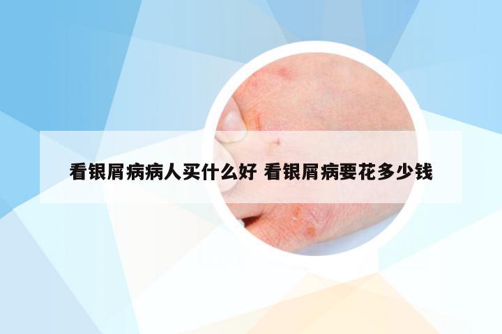 看银屑病病人买什么好 看银屑病要花多少钱