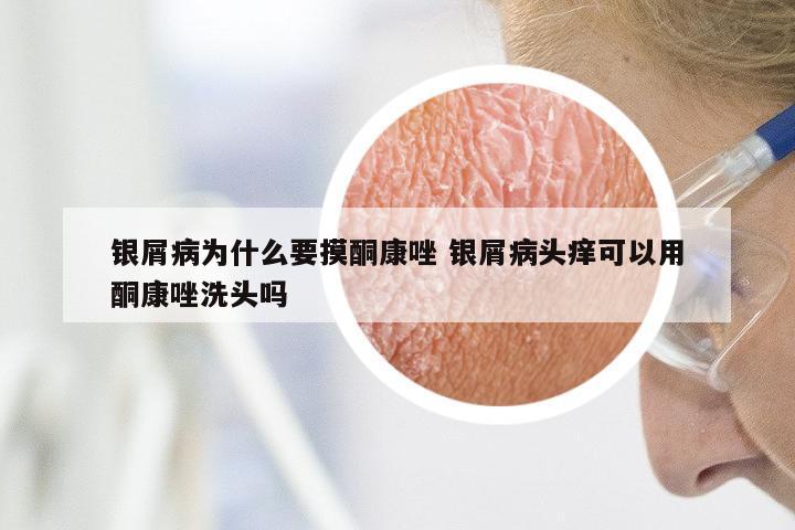 银屑病为什么要摸酮康唑 银屑病头痒可以用酮康唑洗头吗