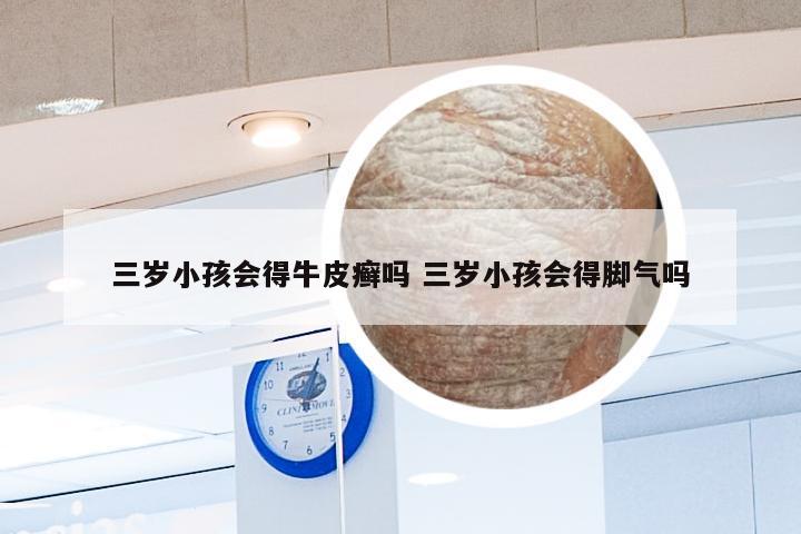 三岁小孩会得牛皮癣吗 三岁小孩会得脚气吗