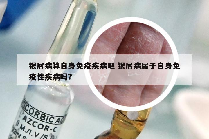 银屑病算自身免疫疾病吧 银屑病属于自身免疫性疾病吗?