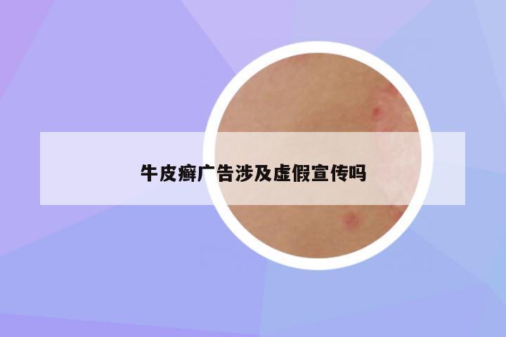 牛皮癣广告涉及虚假宣传吗
