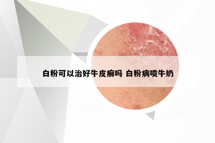 白粉可以治好牛皮癣吗 白粉病喷牛奶