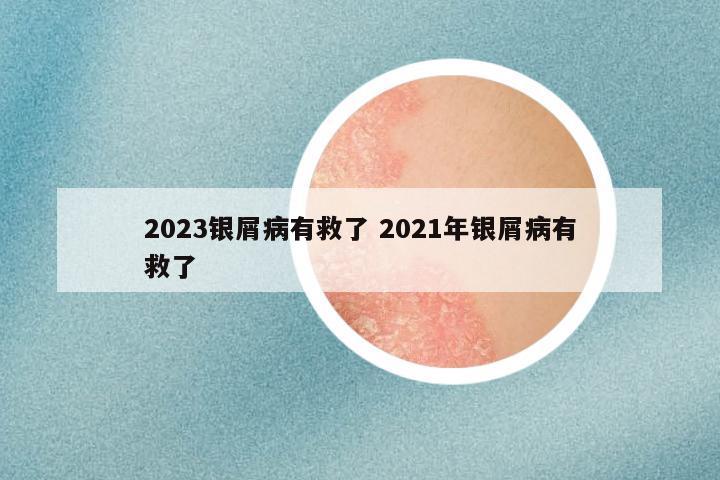 2023银屑病有救了 2021年银屑病有救了