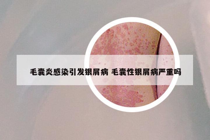 毛囊炎感染引发银屑病 毛囊性银屑病严重吗