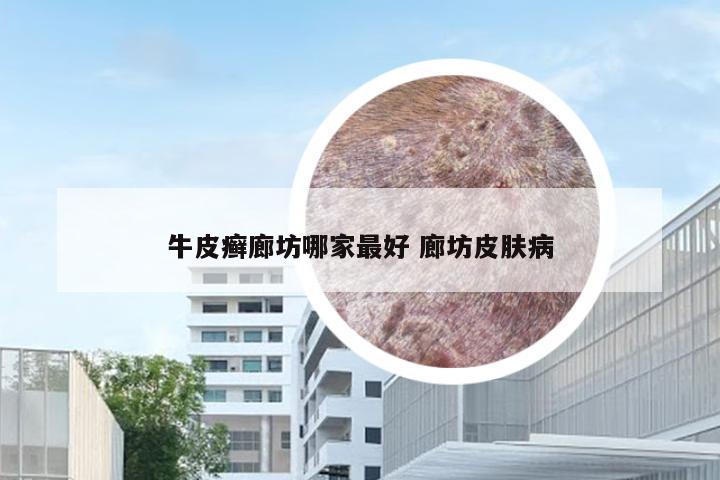 牛皮癣廊坊哪家最好 廊坊皮肤病
