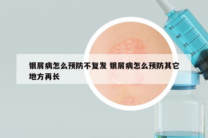 银屑病怎么预防不复发 银屑病怎么预防其它地方再长
