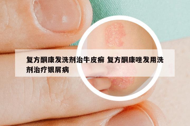 复方酮康发洗剂治牛皮癣 复方酮康唑发用洗剂治疗银屑病