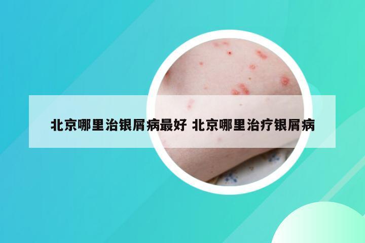 北京哪里治银屑病最好 北京哪里治疗银屑病