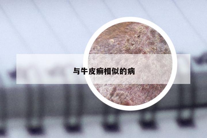 与牛皮癣相似的病