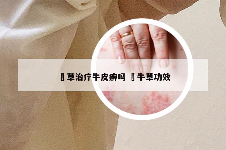 葎草治疗牛皮癣吗 牻牛草功效