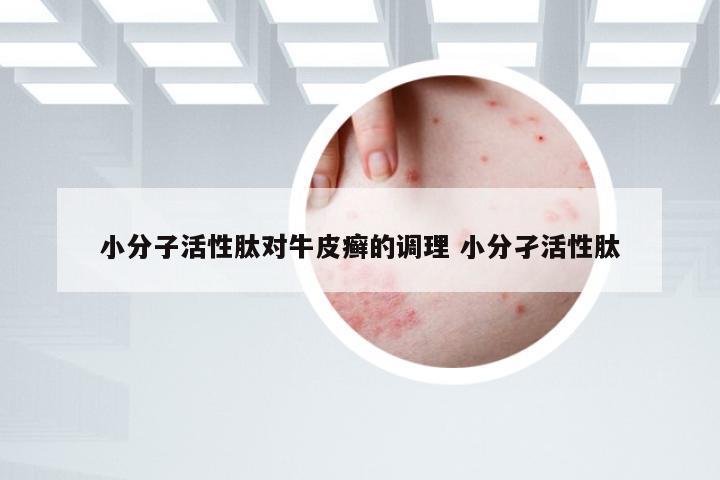 小分子活性肽对牛皮癣的调理 小分孑活性肽