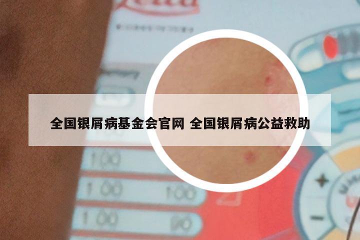 全国银屑病基金会官网 全国银屑病公益救助