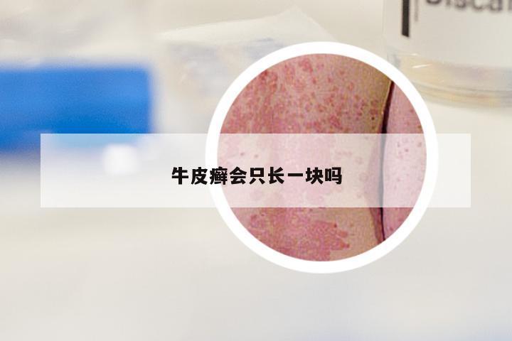 牛皮癣会只长一块吗