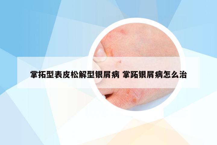 掌拓型表皮松解型银屑病 掌跖银屑病怎么治